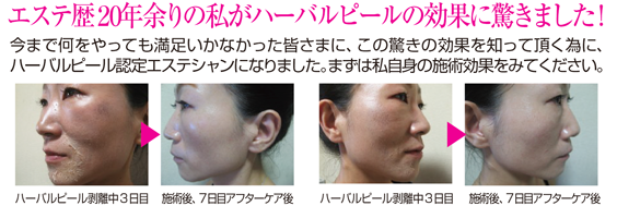 エステ歴20年余りの私がハーバルピールの効果に驚きました！ 今まで何をやっても満足いかなかった皆さまに、この驚きの効果を知って頂く為に、ハーバルピール認定エステシャンになりました。まずは私自身の施術効果をみてください。